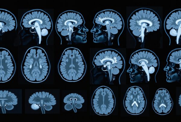 Brain mapping through medical imaging. A collection of MRI brain scans.